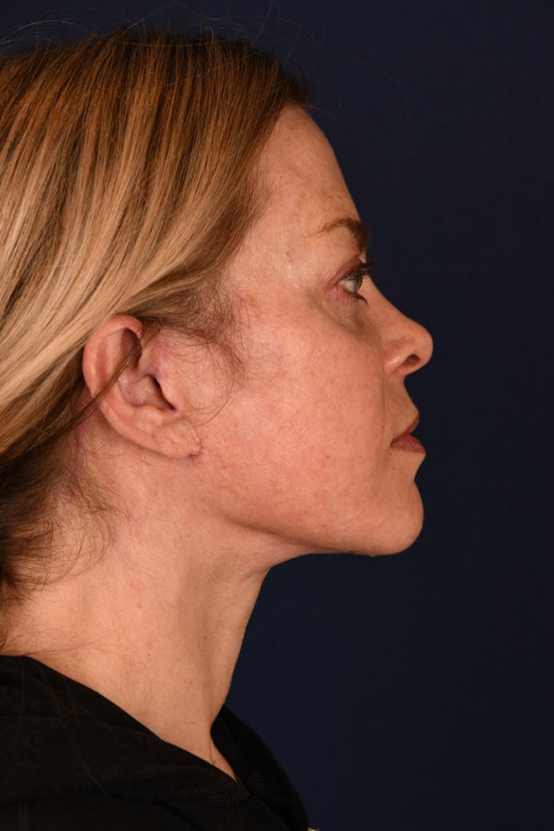 Facelift Before & After Gallery - Patient 9698374 - Image 6