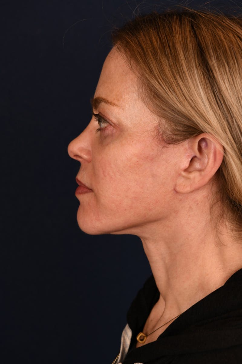 Facelift Before & After Gallery - Patient 9698374 - Image 10