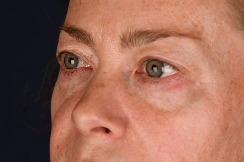 Blepharoplasty Before & After Gallery - Patient 259352 - Image 5
