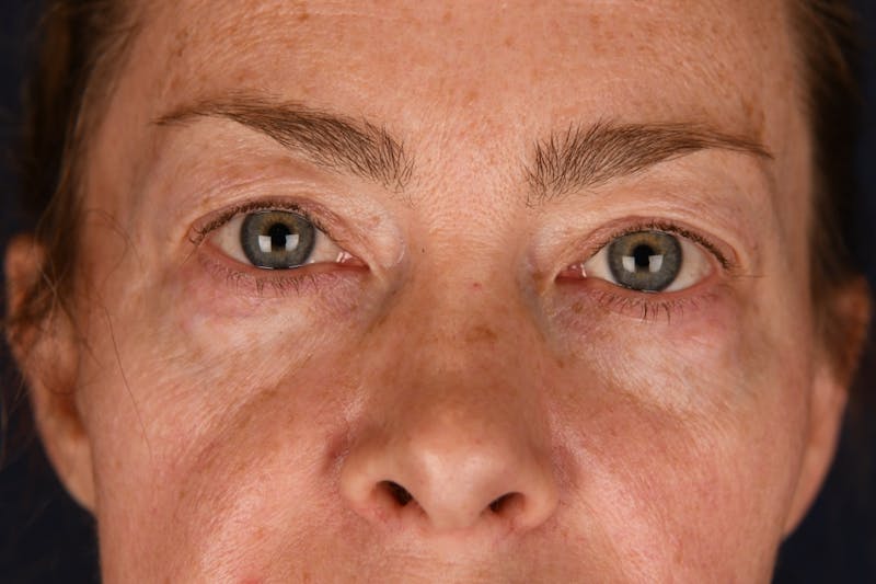 Blepharoplasty Before & After Gallery - Patient 259352 - Image 1
