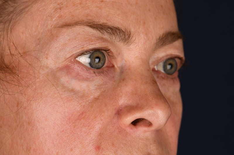 Blepharoplasty Before & After Gallery - Patient 259352 - Image 3