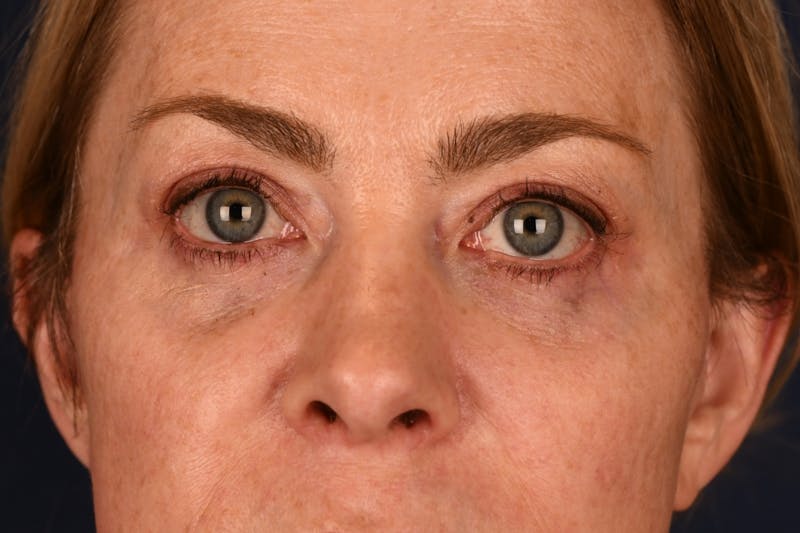 Blepharoplasty Before & After Gallery - Patient 259352 - Image 2