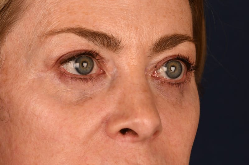 Blepharoplasty Before & After Gallery - Patient 259352 - Image 4