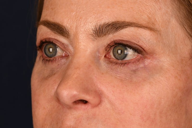 Blepharoplasty Before & After Gallery - Patient 259352 - Image 6