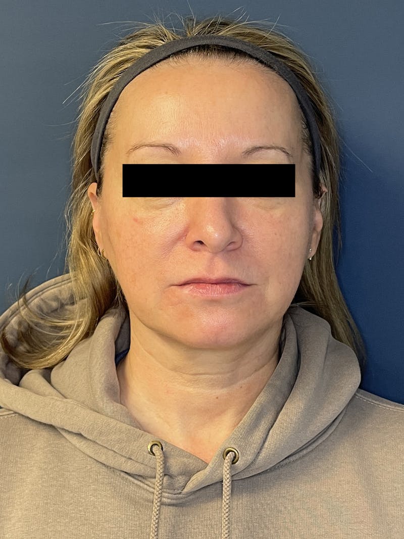 Facial Fillers Before & After Gallery - Patient 391945 - Image 1