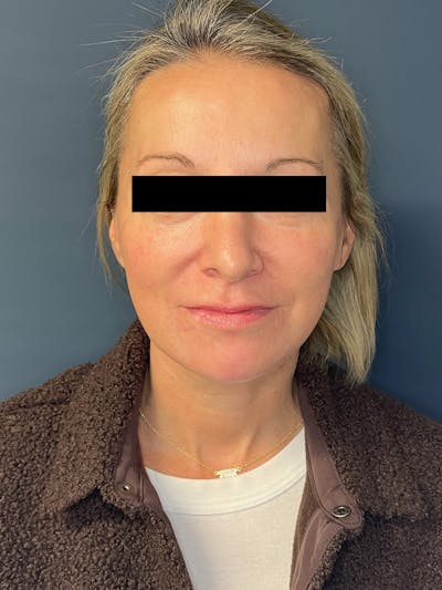 Facial Fillers Before & After Gallery - Patient 391945 - Image 2