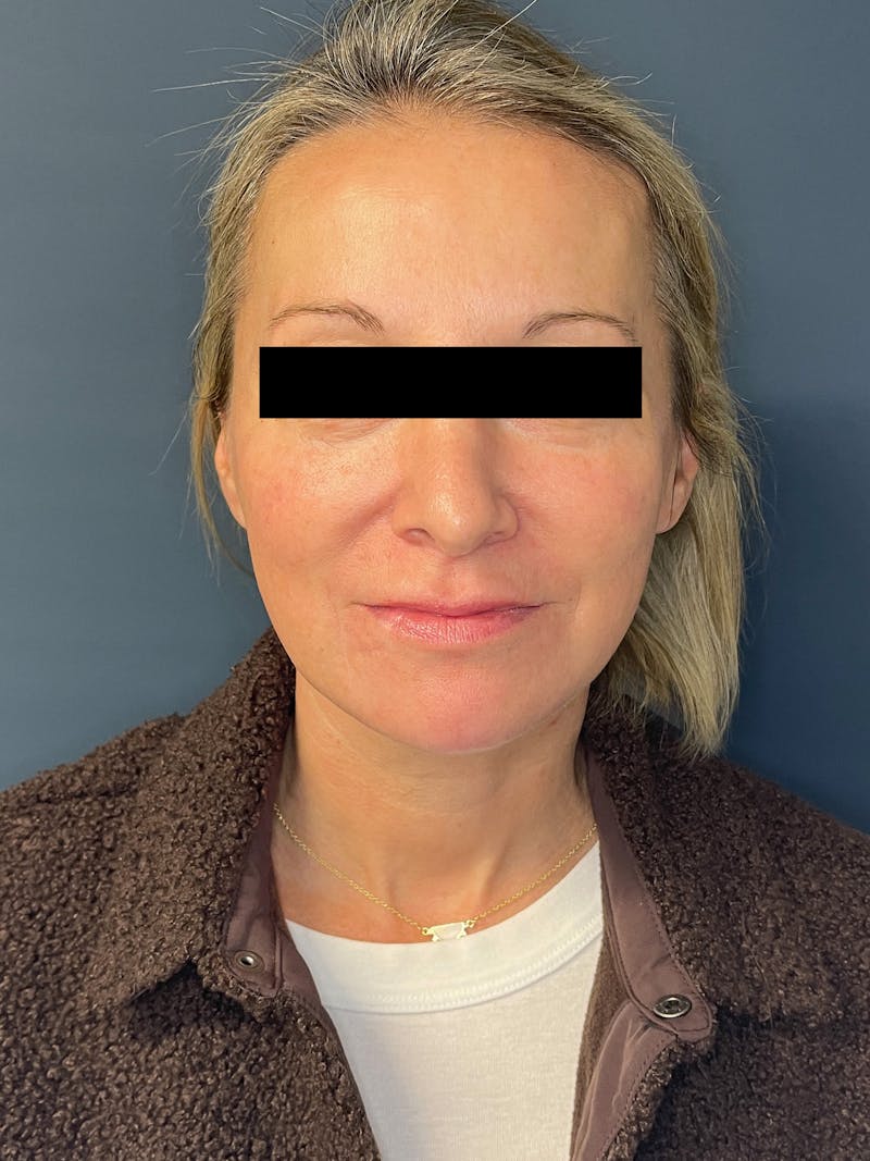 Facial Fillers Before & After Gallery - Patient 391945 - Image 2