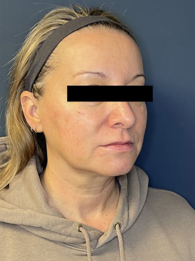 Facial Fillers Before & After Gallery - Patient 391945 - Image 3