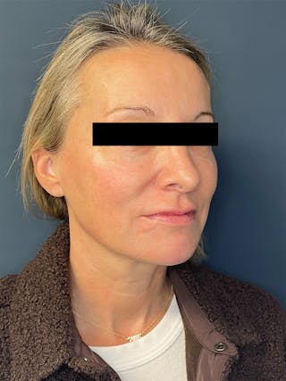 Facial Fillers Before & After Gallery - Patient 391945 - Image 4