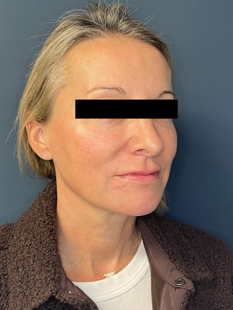 Facial Fillers Before & After Gallery - Patient 391945 - Image 4