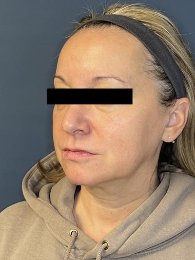 Facial Fillers Before & After Gallery - Patient 391945 - Image 5