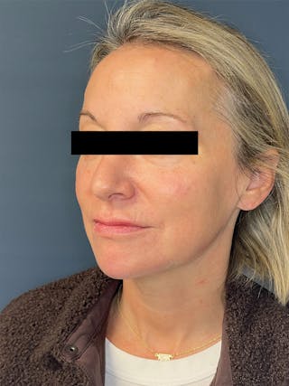 Facial Fillers Before & After Gallery - Patient 391945 - Image 6