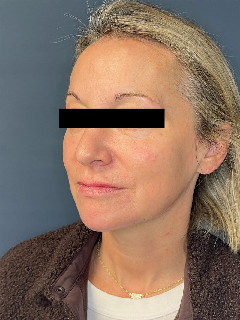 Facial Fillers Before & After Gallery - Patient 391945 - Image 6