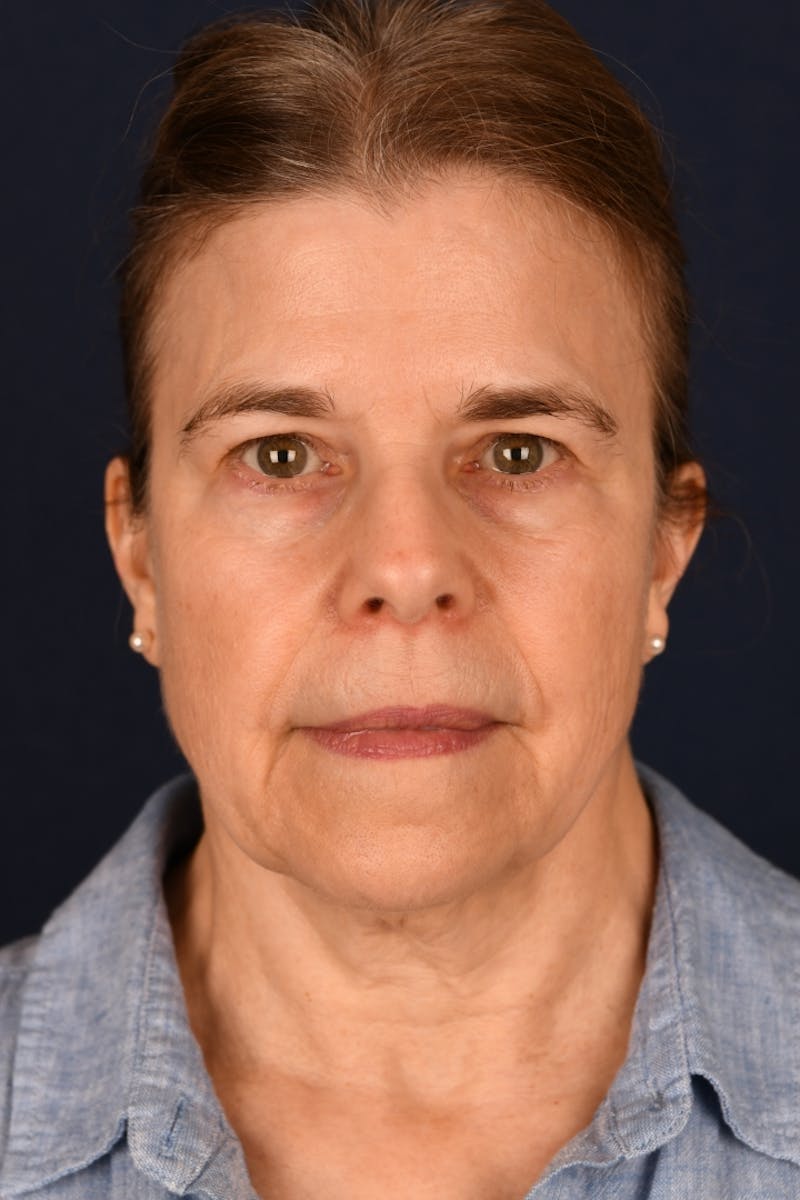 Facelift Before & After Gallery - Patient 301184 - Image 1