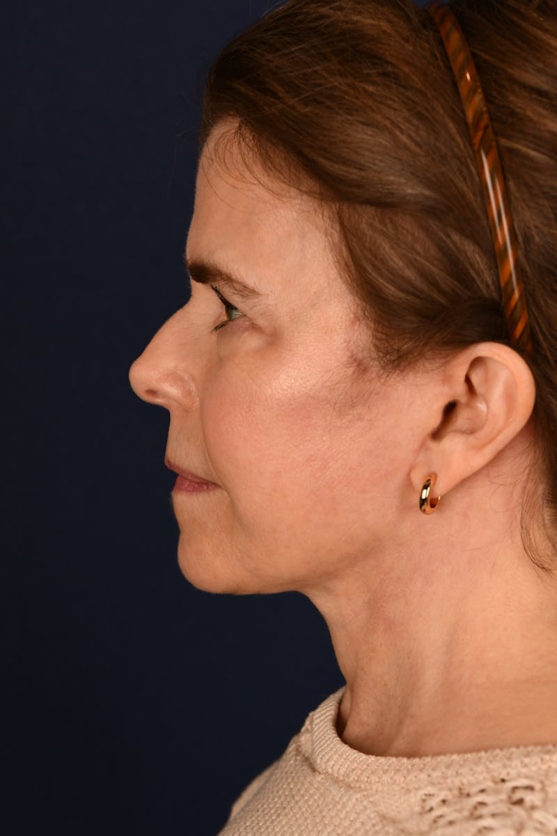Facelift Before & After Gallery - Patient 301184 - Image 10
