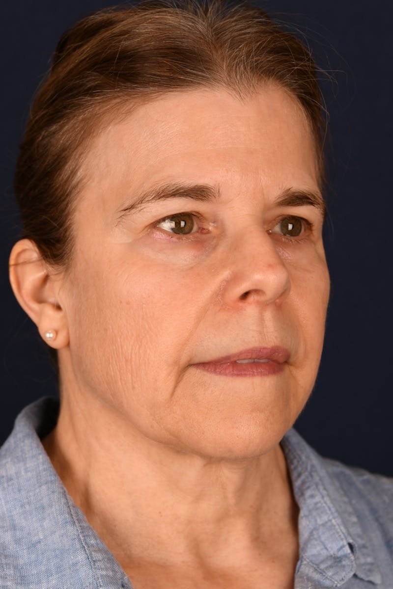 Facelift Before & After Gallery - Patient 301184 - Image 3