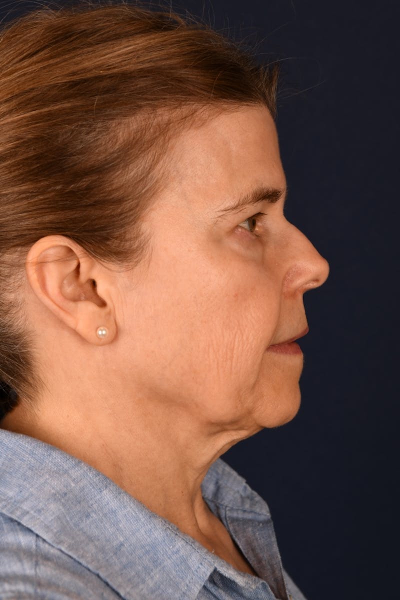 Facelift Before & After Gallery - Patient 301184 - Image 5