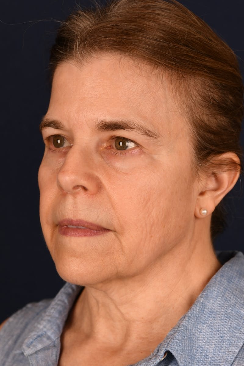 Facelift Before & After Gallery - Patient 301184 - Image 7
