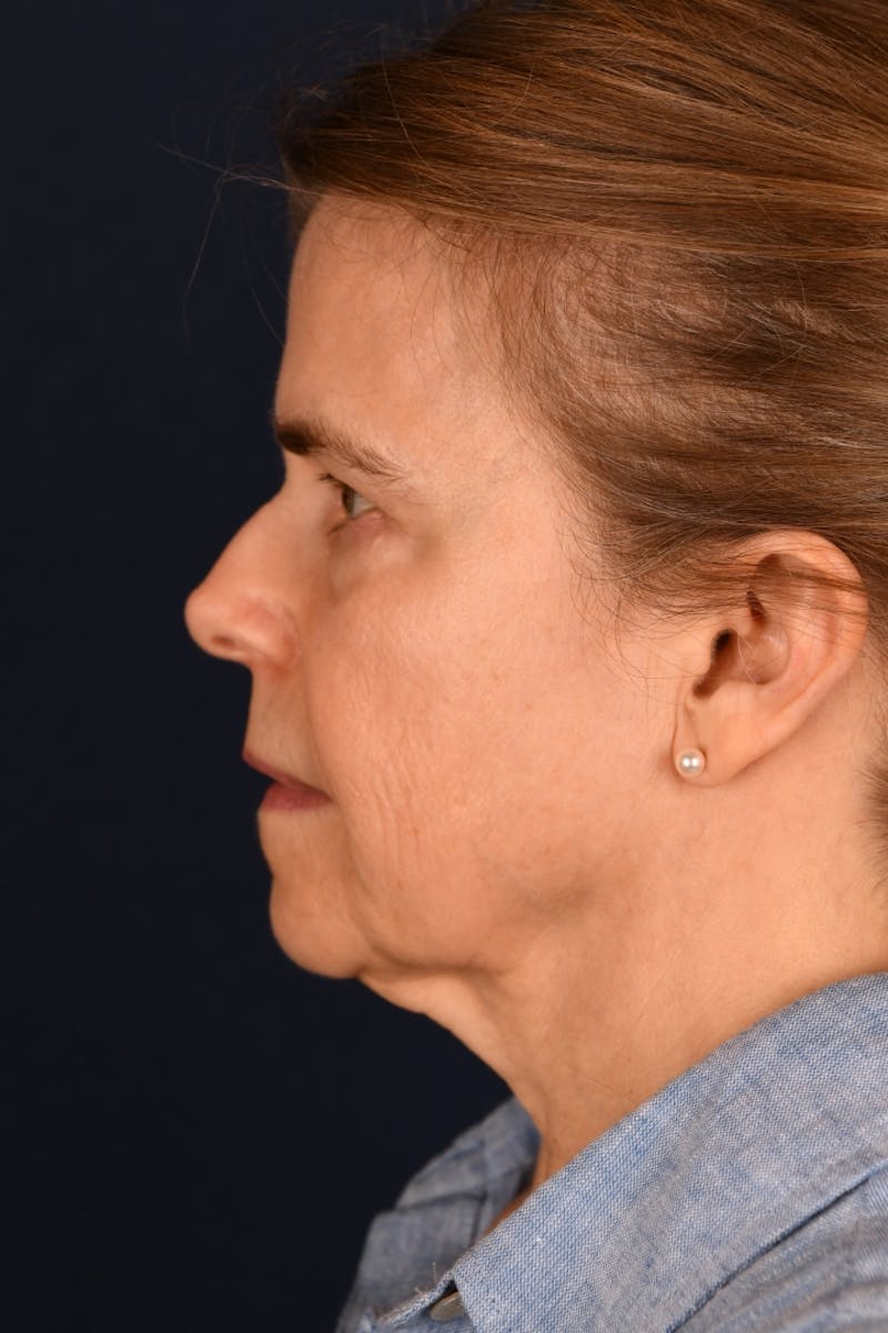 Facelift Before & After Gallery - Patient 301184 - Image 9