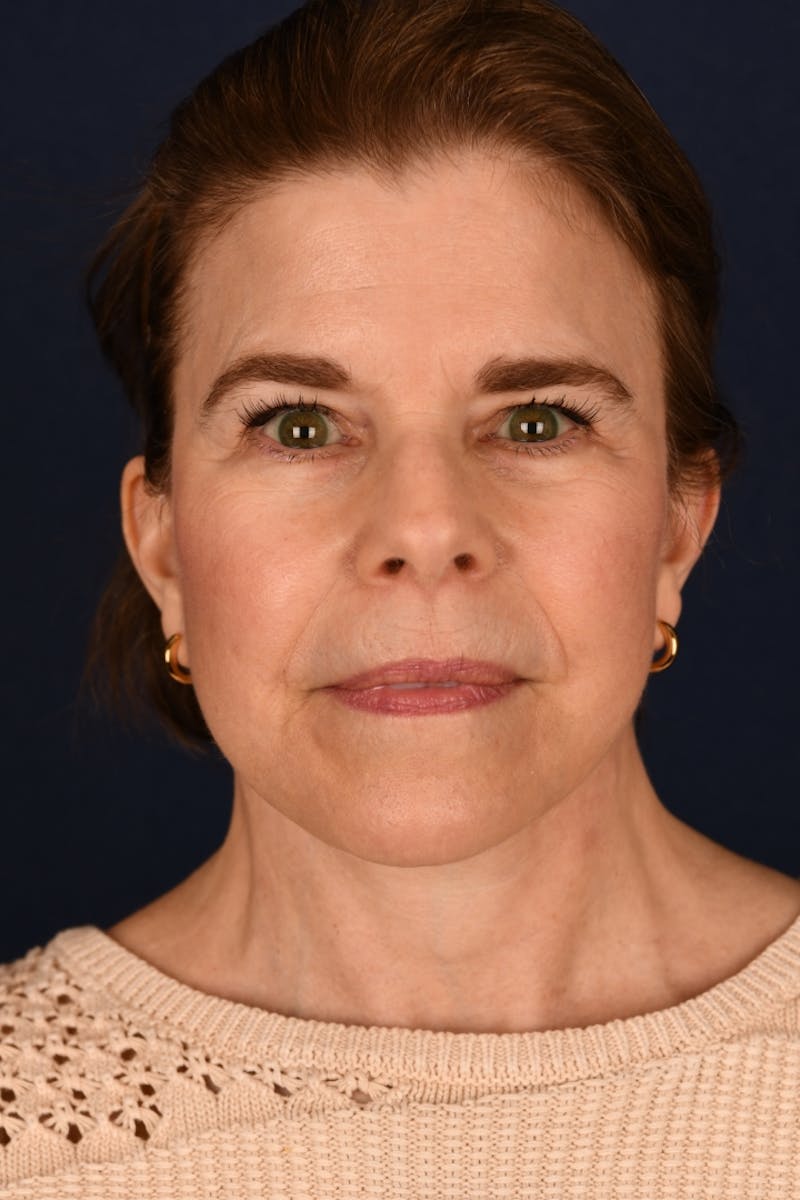 Facelift Before & After Gallery - Patient 301184 - Image 2
