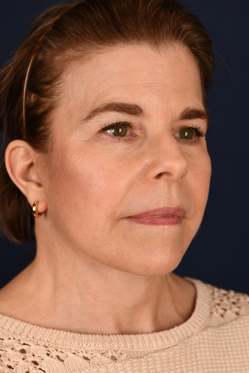 Facelift Before & After Gallery - Patient 301184 - Image 4