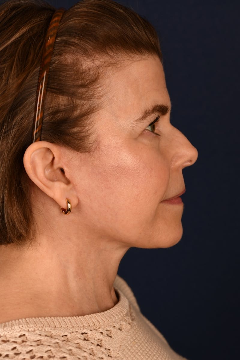 Facelift Before & After Gallery - Patient 301184 - Image 6