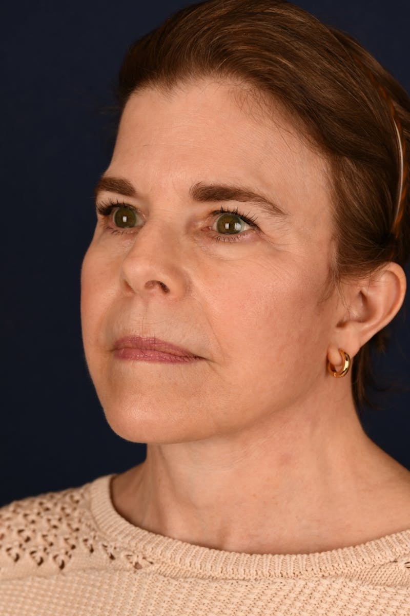 Facelift Before & After Gallery - Patient 301184 - Image 8