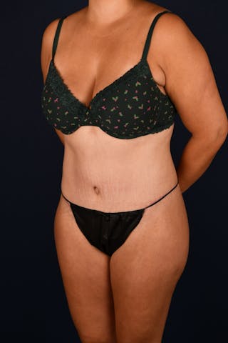 Abdominoplasty Before & After Gallery - Patient 268245 - Image 6