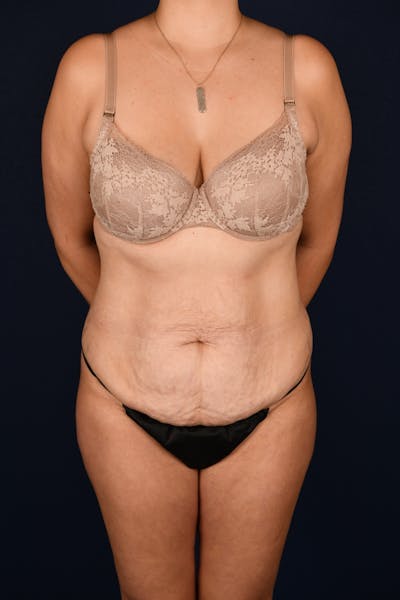 Abdominoplasty Before & After Gallery - Patient 268245 - Image 1