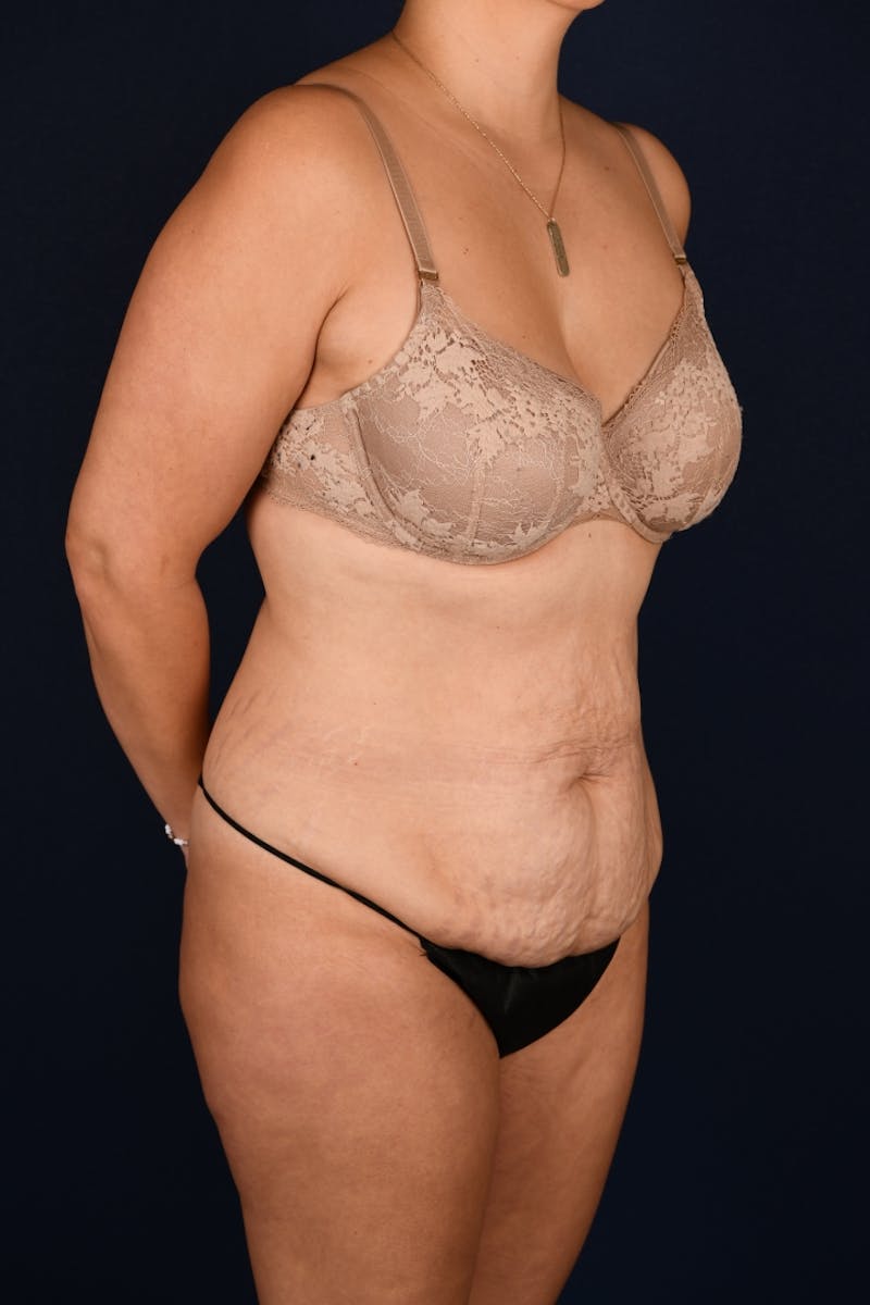 Abdominoplasty Before & After Gallery - Patient 268245 - Image 3
