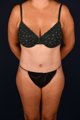 Abdominoplasty Before & After Gallery - Patient 268245 - Image 2