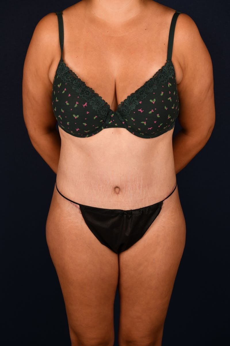 Abdominoplasty Before & After Gallery - Patient 268245 - Image 2