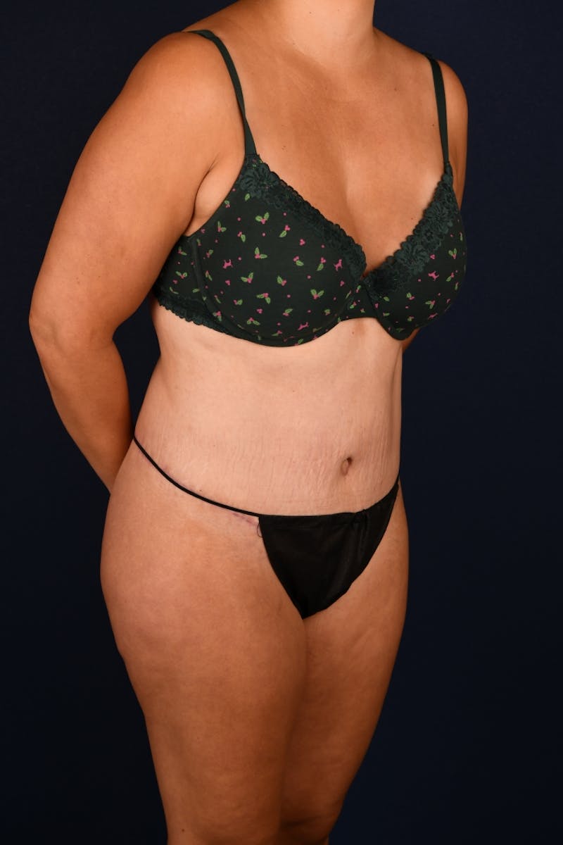 Abdominoplasty Before & After Gallery - Patient 268245 - Image 4