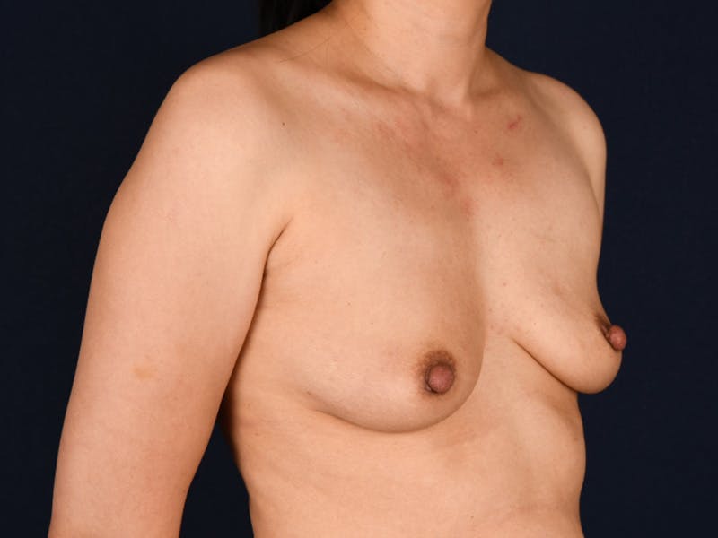 AFT Before & After Gallery - Patient 176849 - Image 3