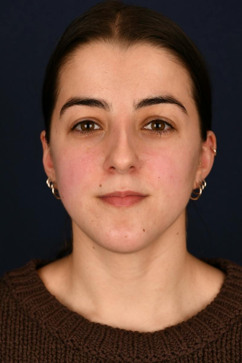 Rhinoplasty Before & After Gallery - Patient 242456 - Image 1