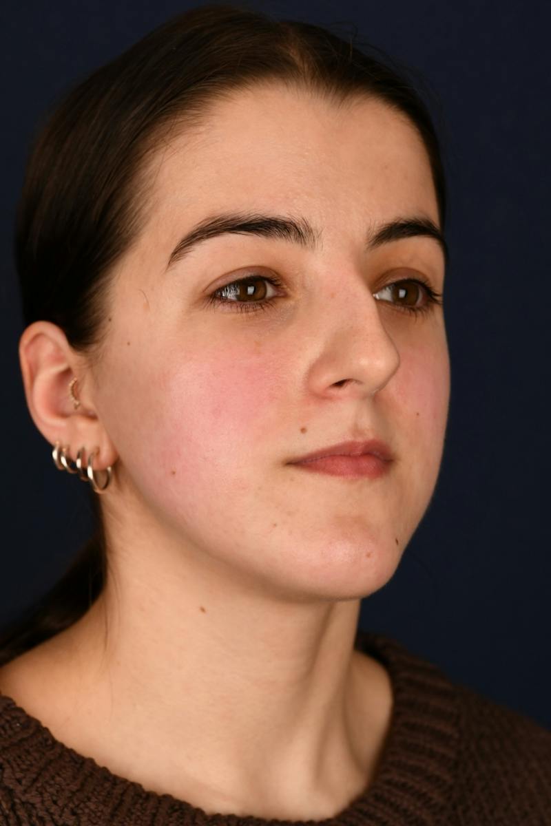 Rhinoplasty Before & After Gallery - Patient 242456 - Image 3