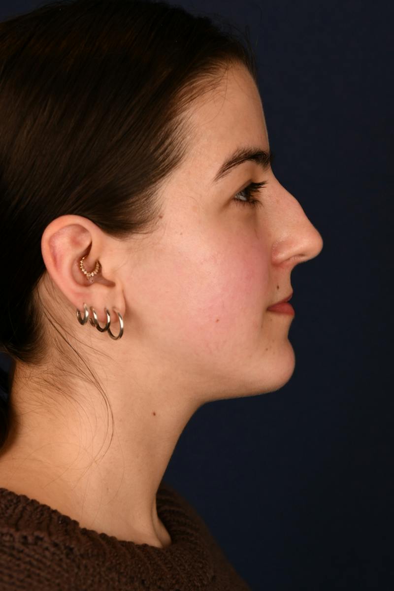Rhinoplasty Before & After Gallery - Patient 242456 - Image 5