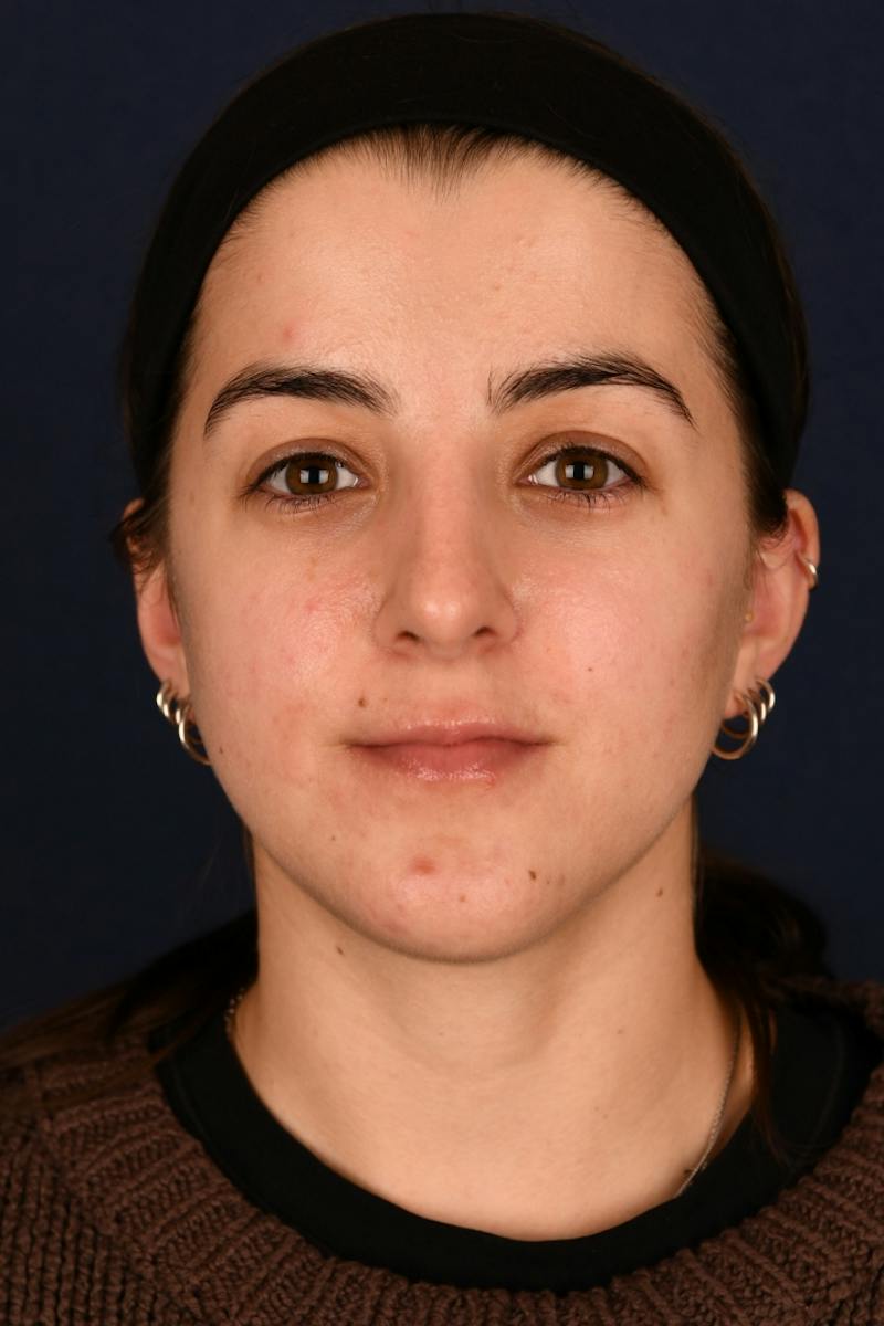 Rhinoplasty Before & After Gallery - Patient 242456 - Image 2