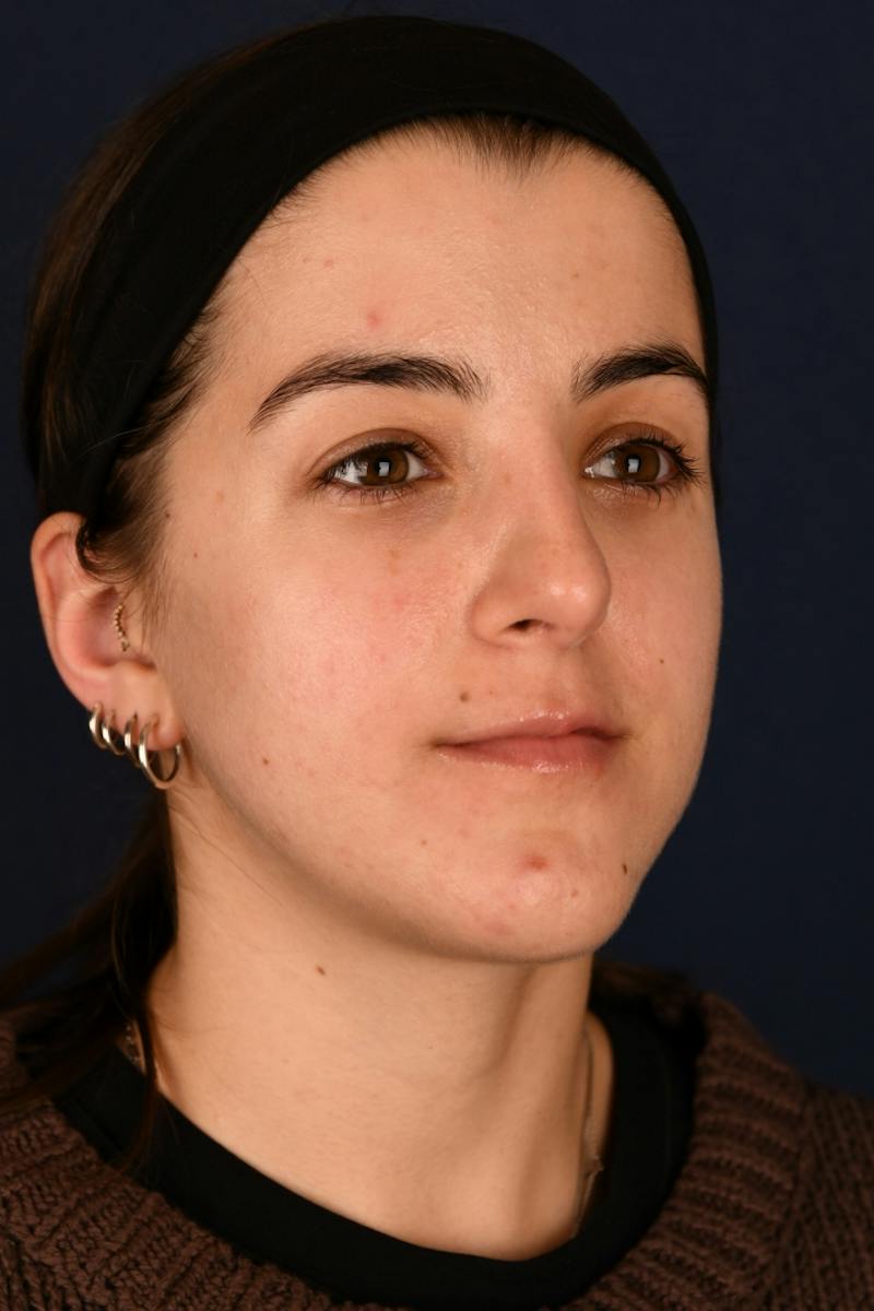 Rhinoplasty Before & After Gallery - Patient 242456 - Image 4