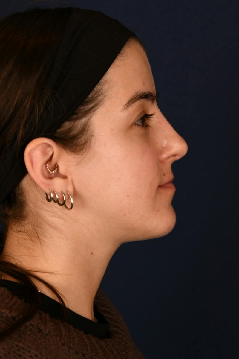 Rhinoplasty Before & After Gallery - Patient 242456 - Image 6