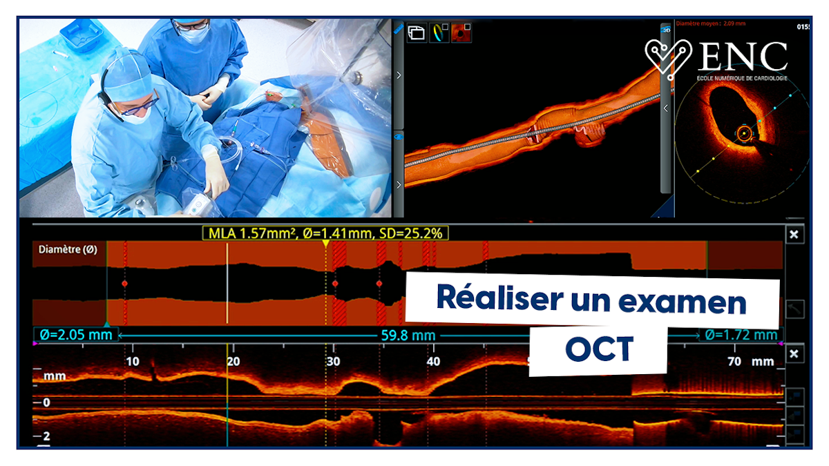 Comment réaliser une OCT