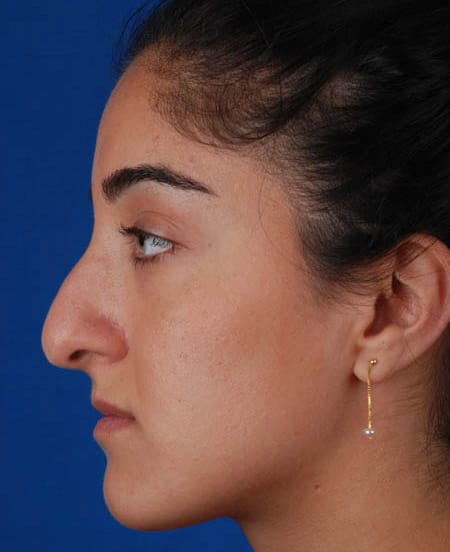 Before rhinoplasty in Torrance with Dr. Marcus