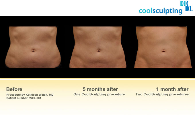coolsculpting-infographic