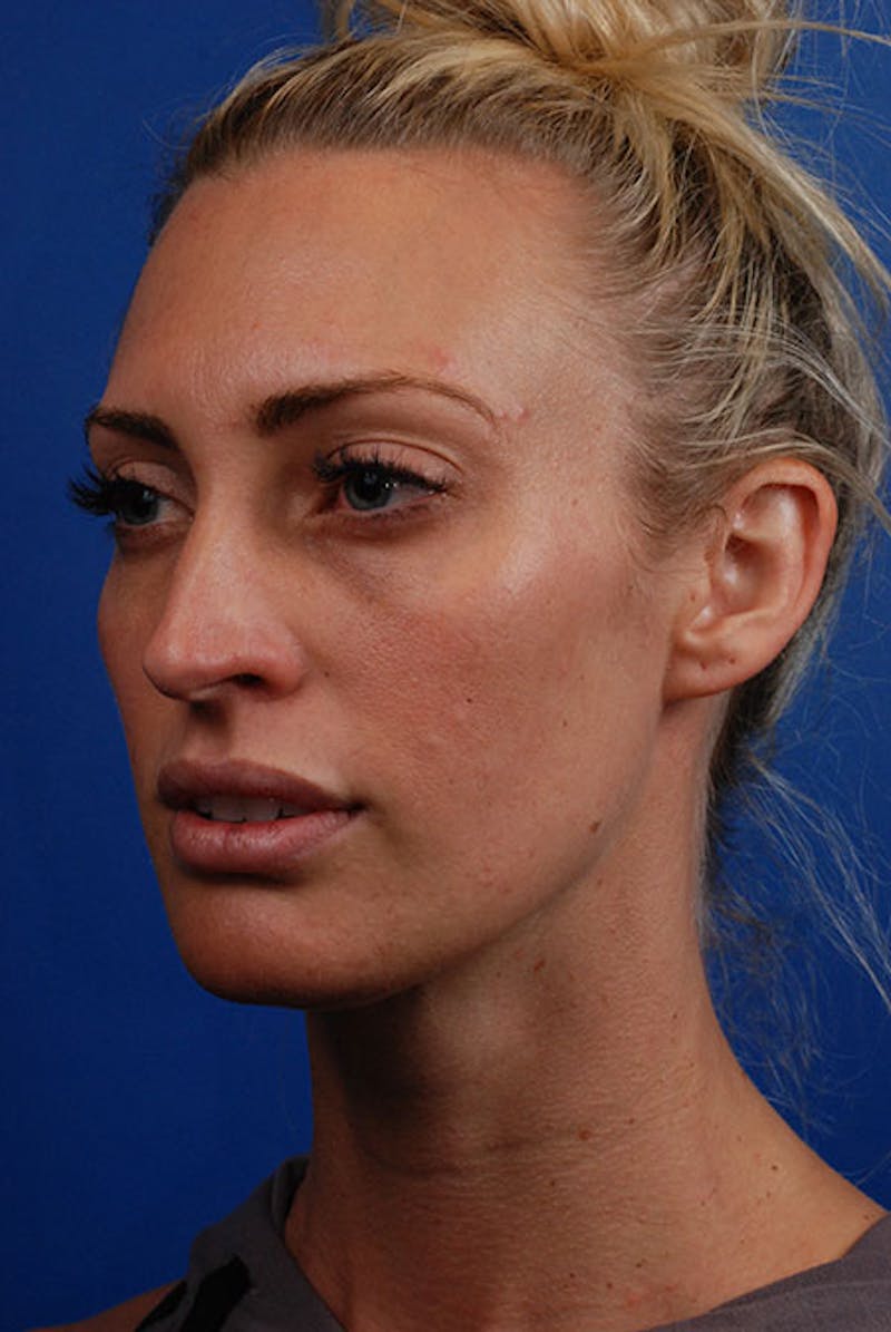 Botox Before & After Gallery - Patient 12973235 - Image 1
