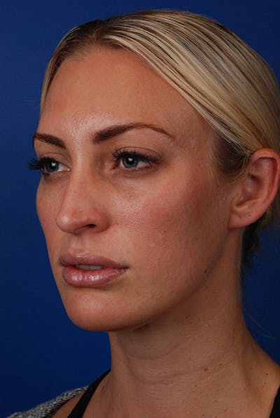 Botox Before & After Gallery - Patient 12973235 - Image 2