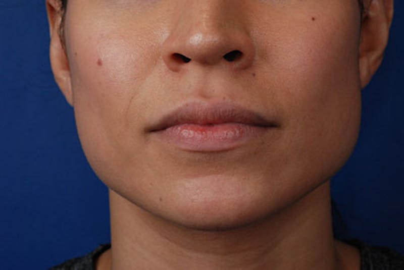 Botox Before & After Gallery - Patient 12973236 - Image 1