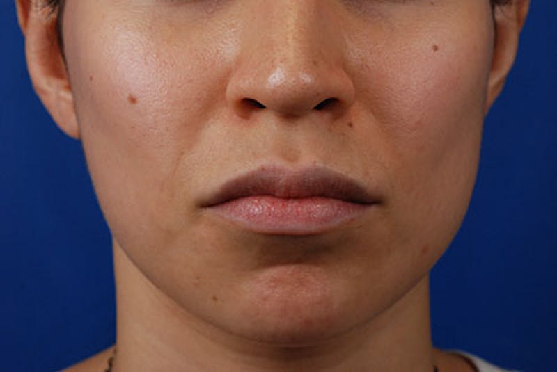 Botox Before & After Gallery - Patient 12973236 - Image 2