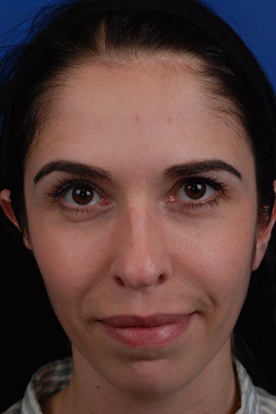 Botox Before & After Gallery - Patient 12973237 - Image 1