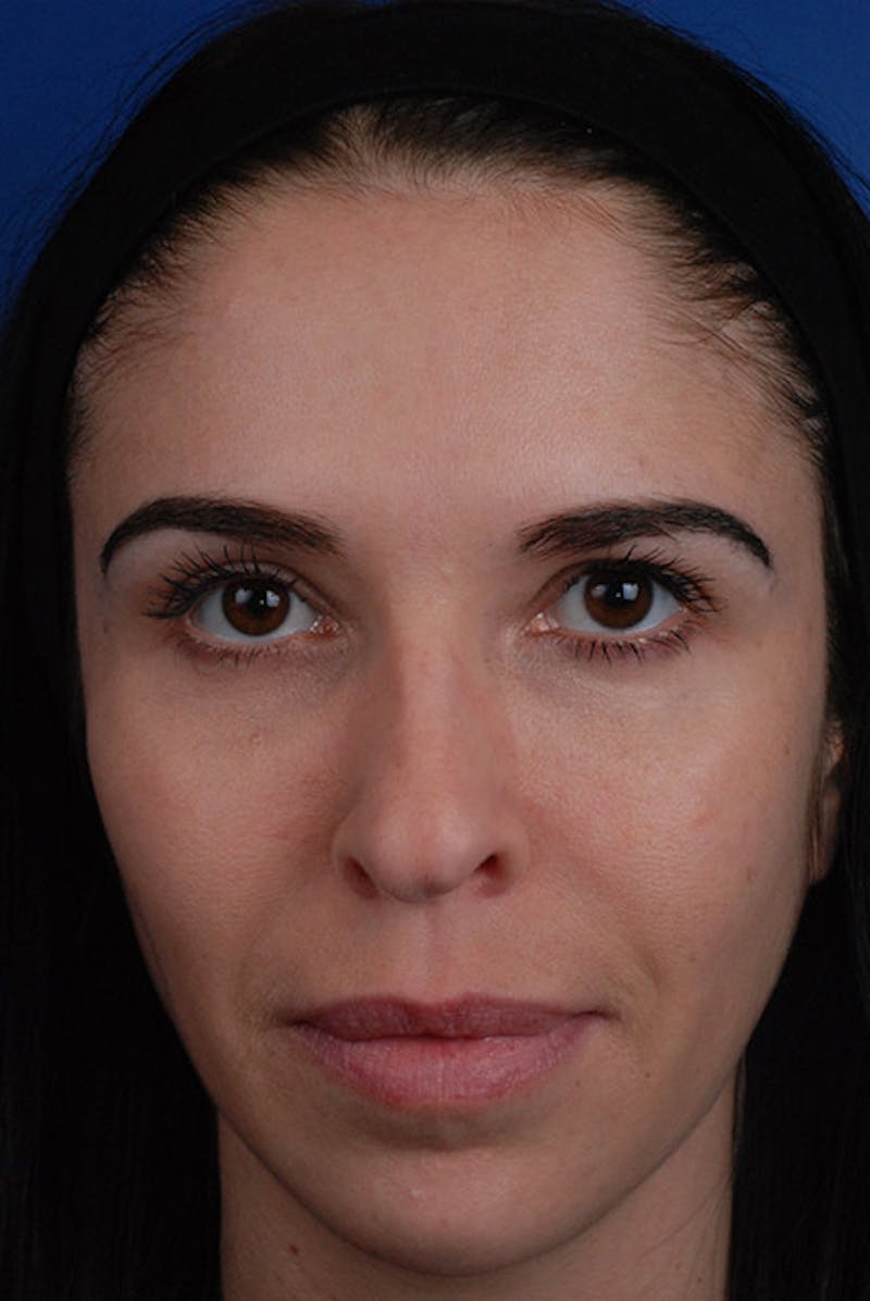 Botox Before & After Gallery - Patient 12973237 - Image 2