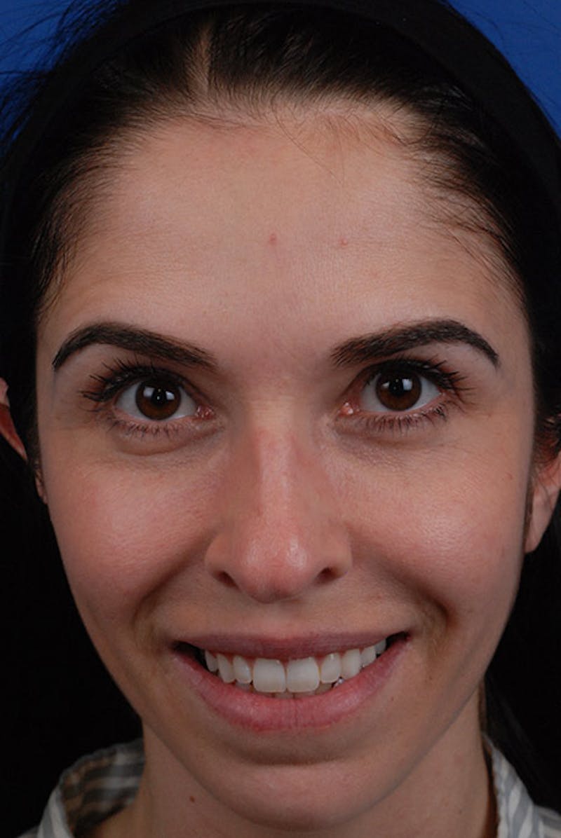 Botox Before & After Gallery - Patient 12973237 - Image 3